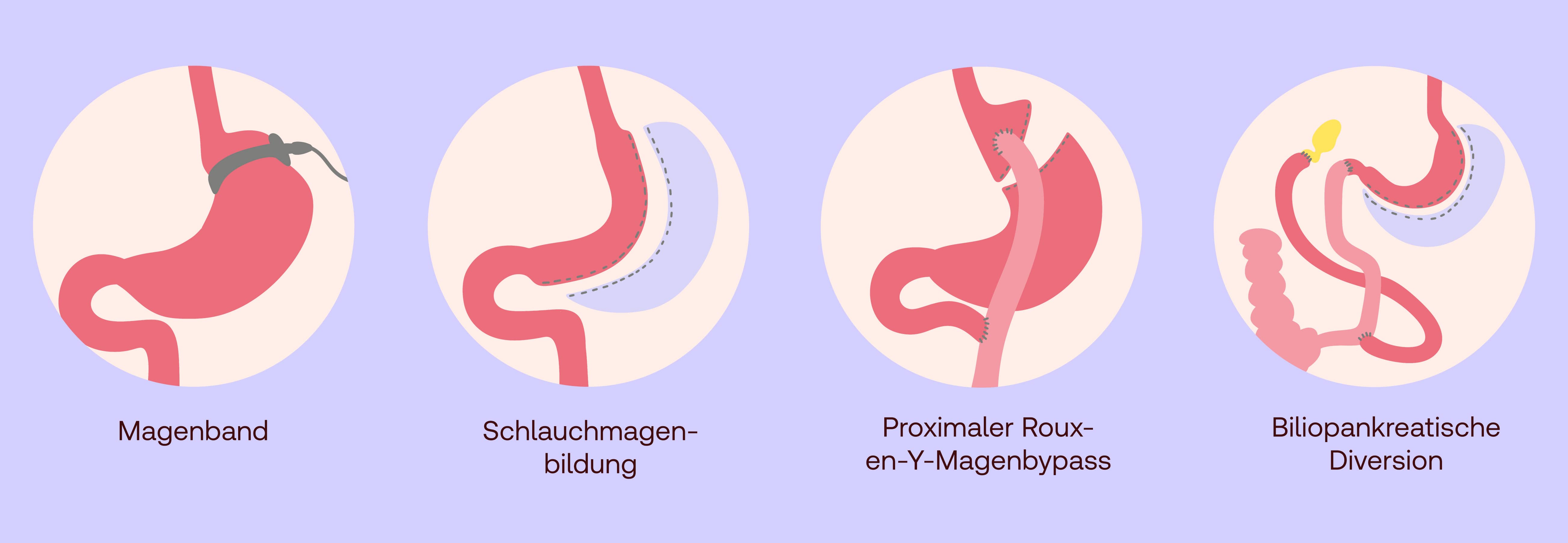 Magenverkleinerung Behandlung Wirkung Shop Apotheke