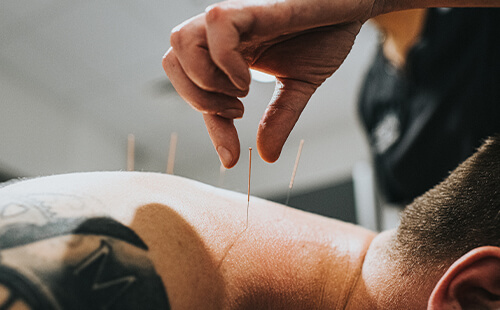 Ein Mann hat Akupunktur-Nadeln im oberen Rücken. 