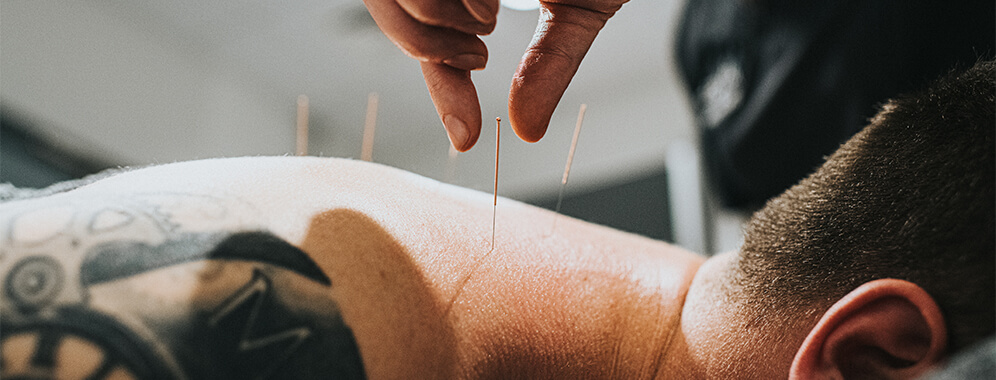 Man sieht einen Mann mit Akupunktur-Nadeln im oberen Rücken. 