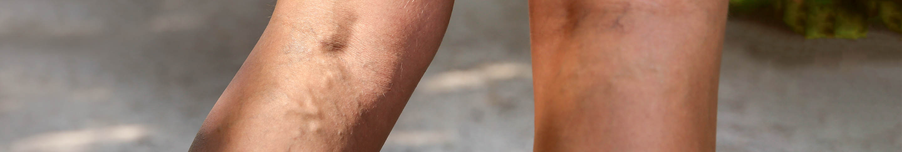 Thrombophlebitis header