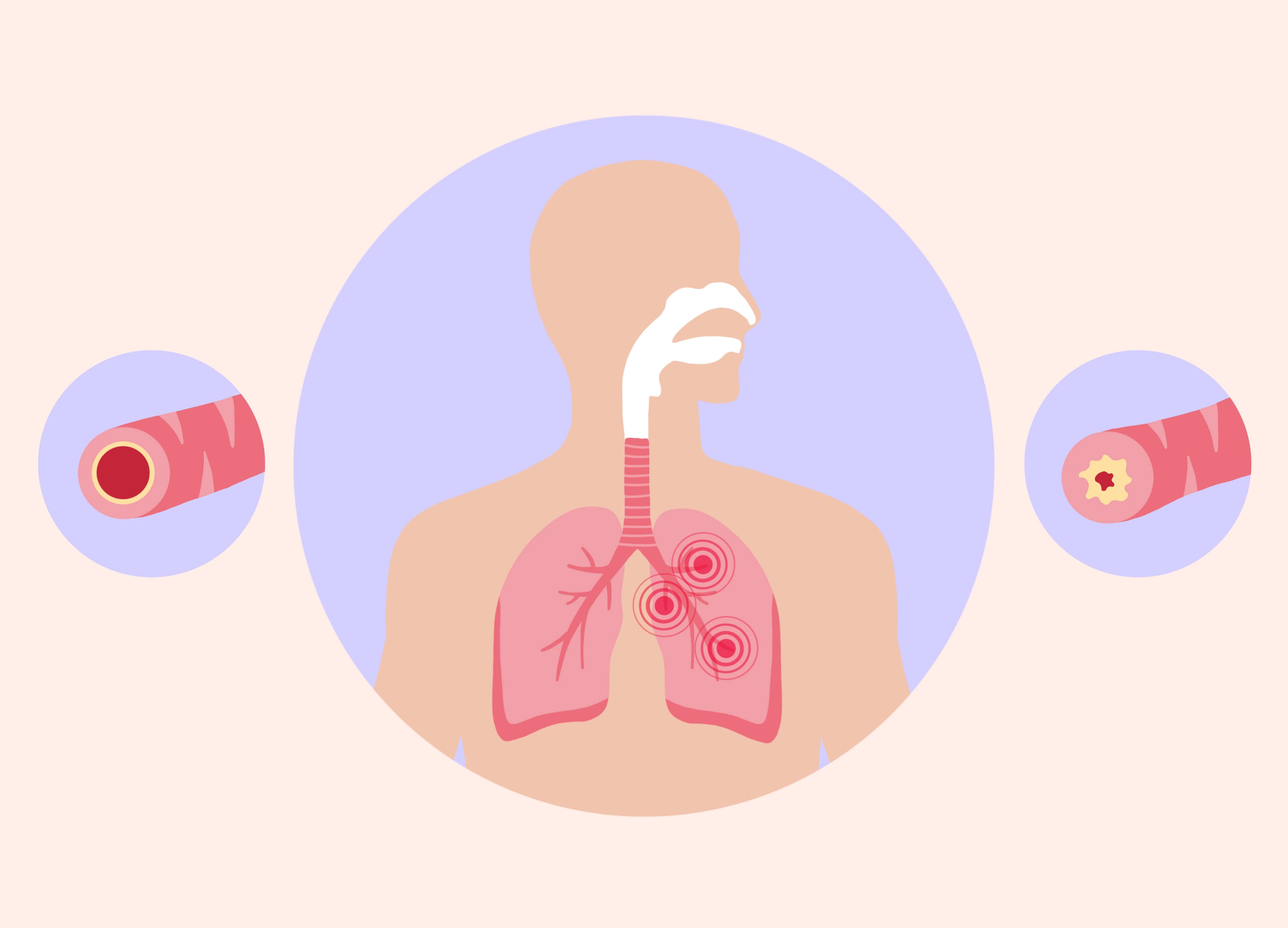 Wie wird Bronchitis behandelt?