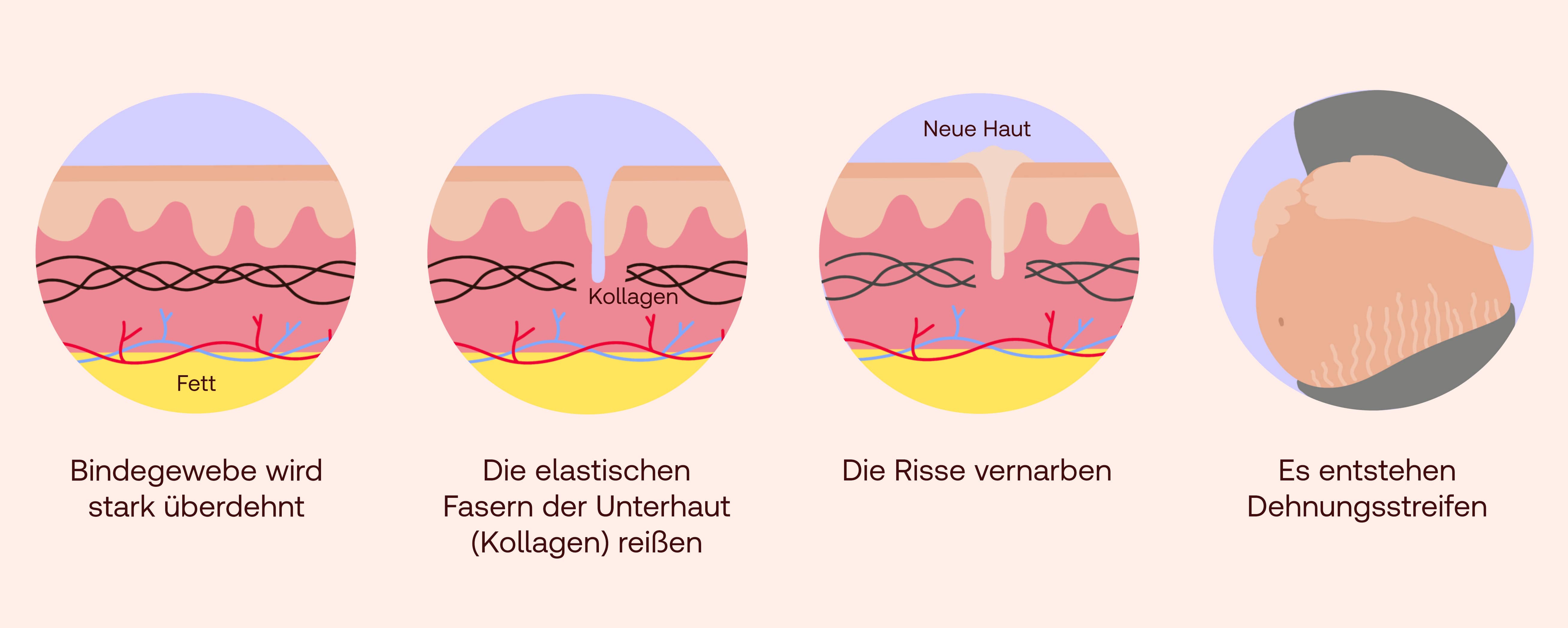 Wie entstehen Dehnungsstreifen