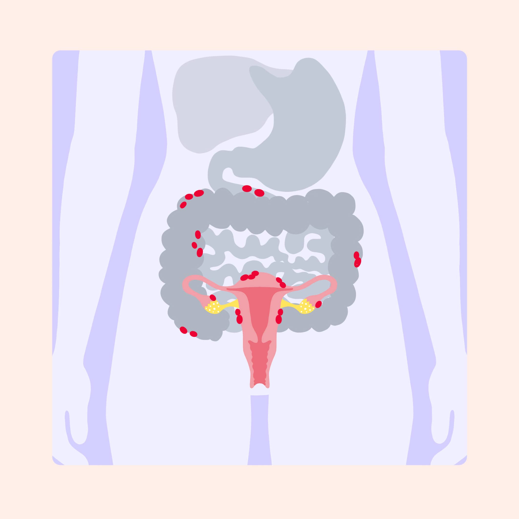Endometrioseherde illustrationen