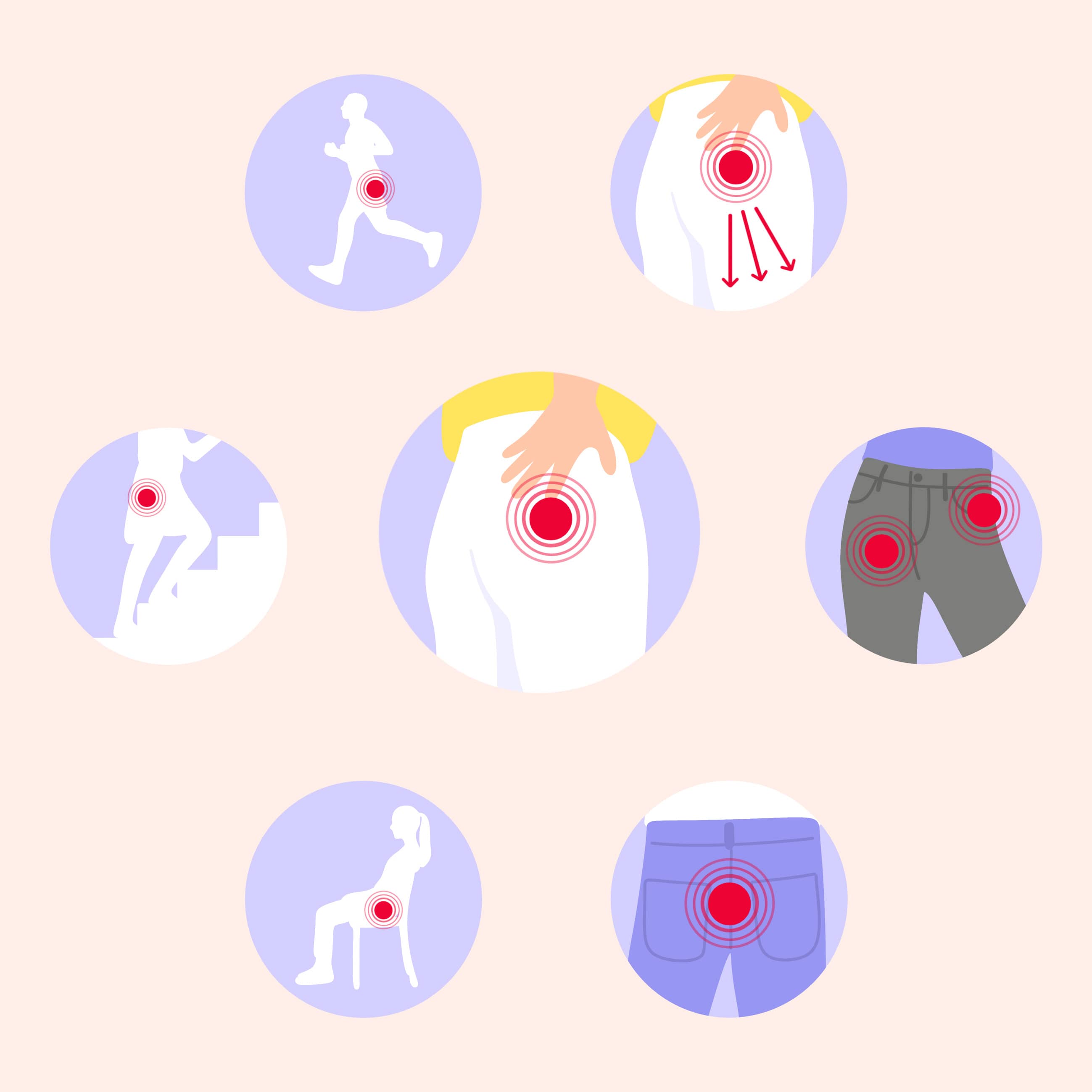 piriformis-syndrom symptome