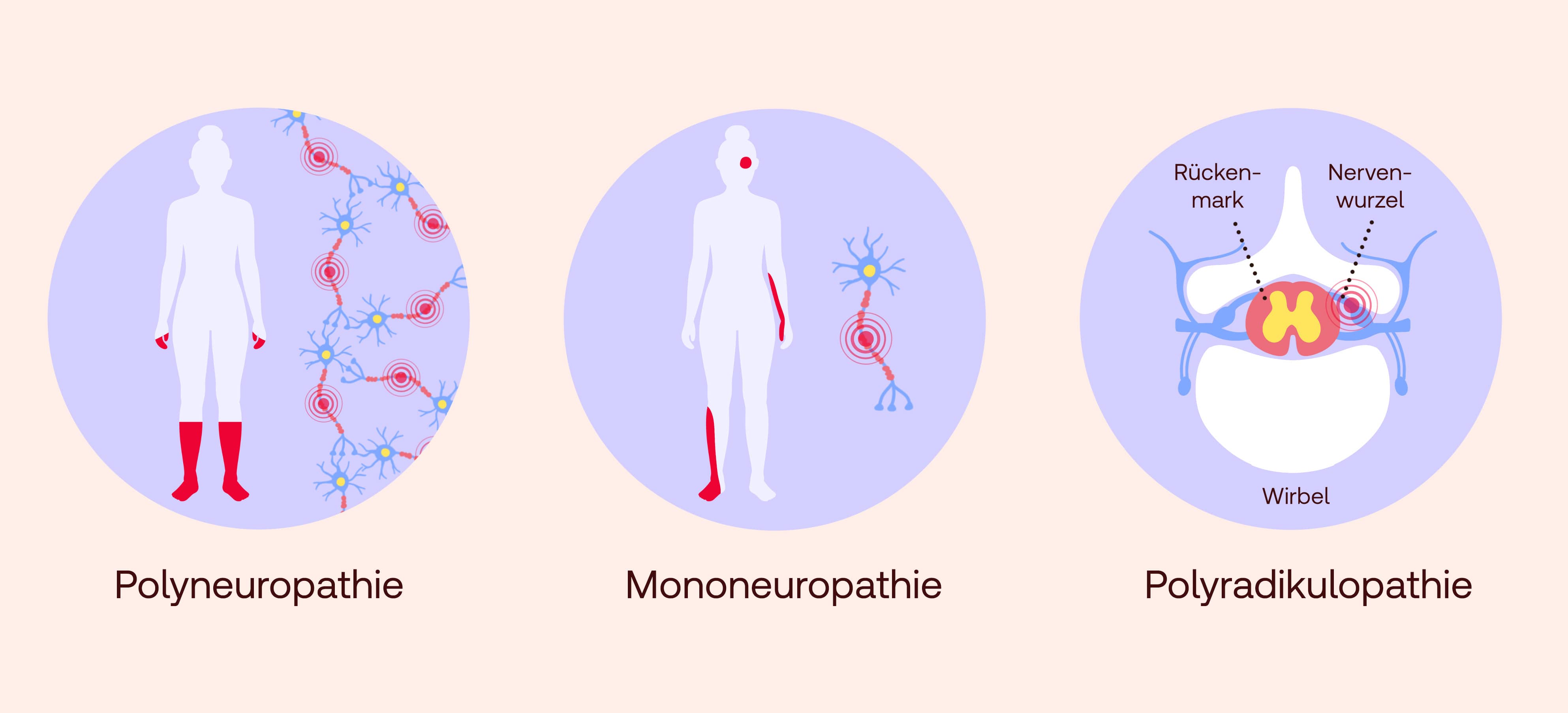 Polyneuropathie Formen