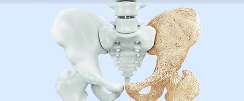 Osteoporose - Ursachen, Symptome und Behandlung