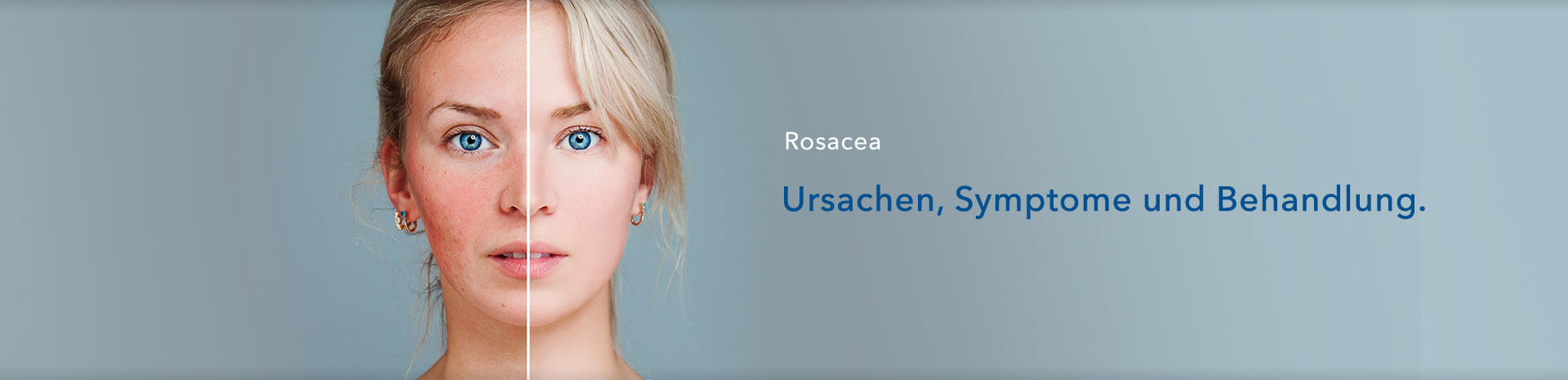 Rosazea: Ursachen, Symptome und Behandlung