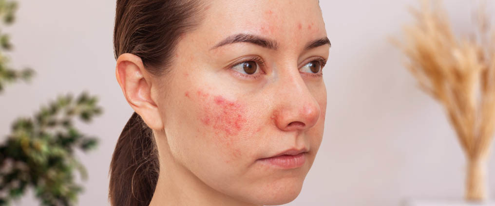 Rosacea - Behandlung, Ursache und Symptome