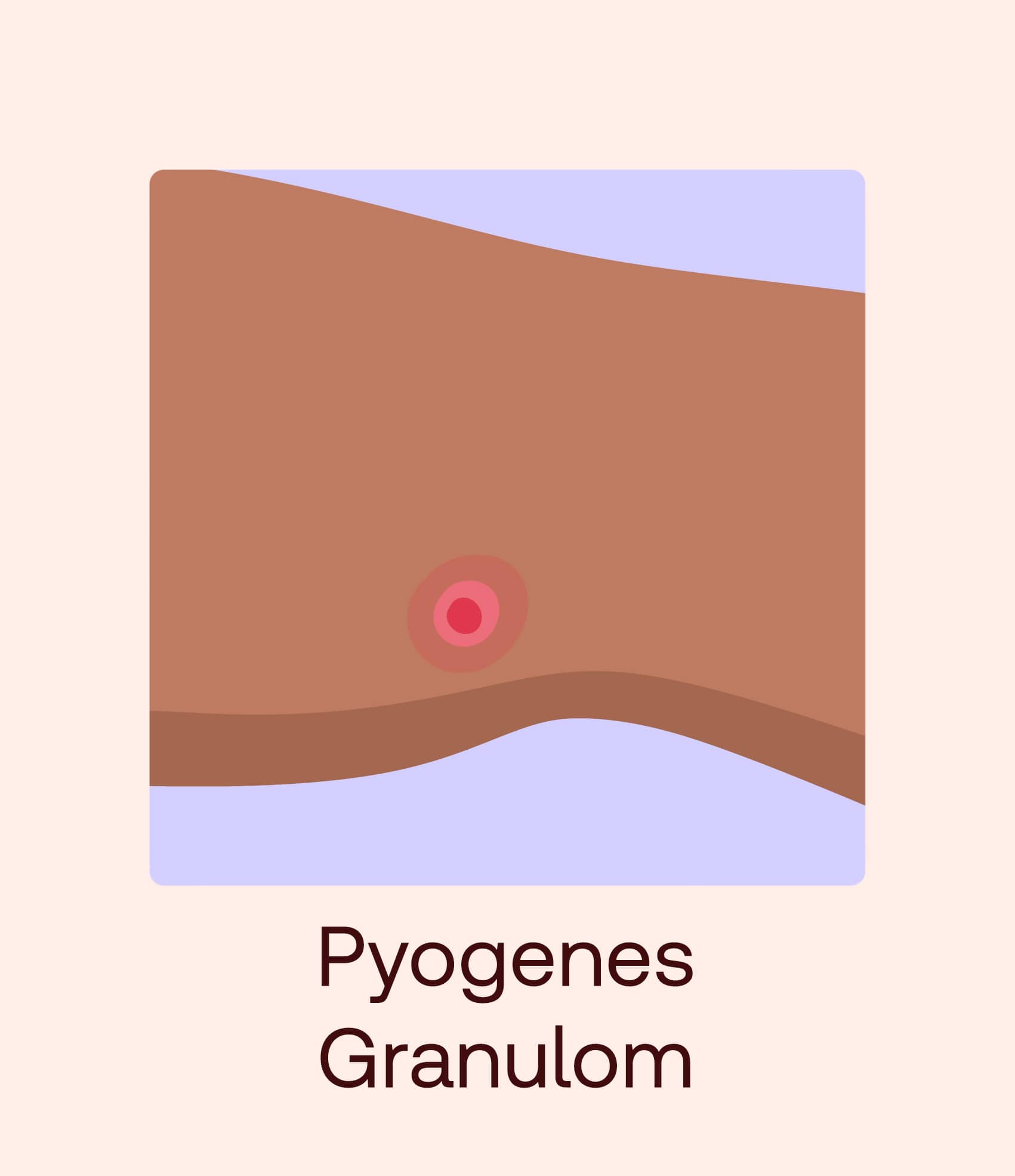 polygenes granulom