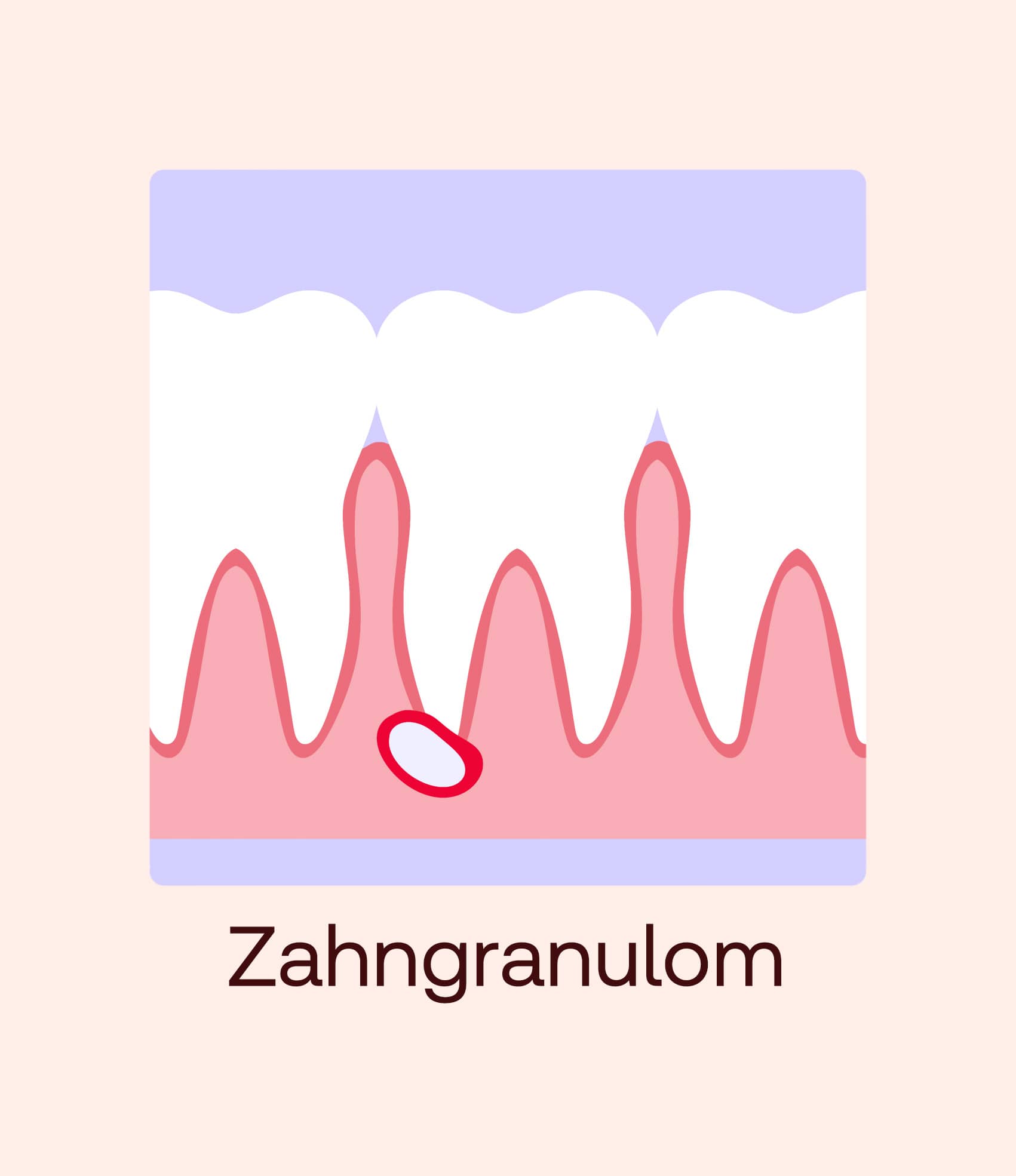 zahngranulom