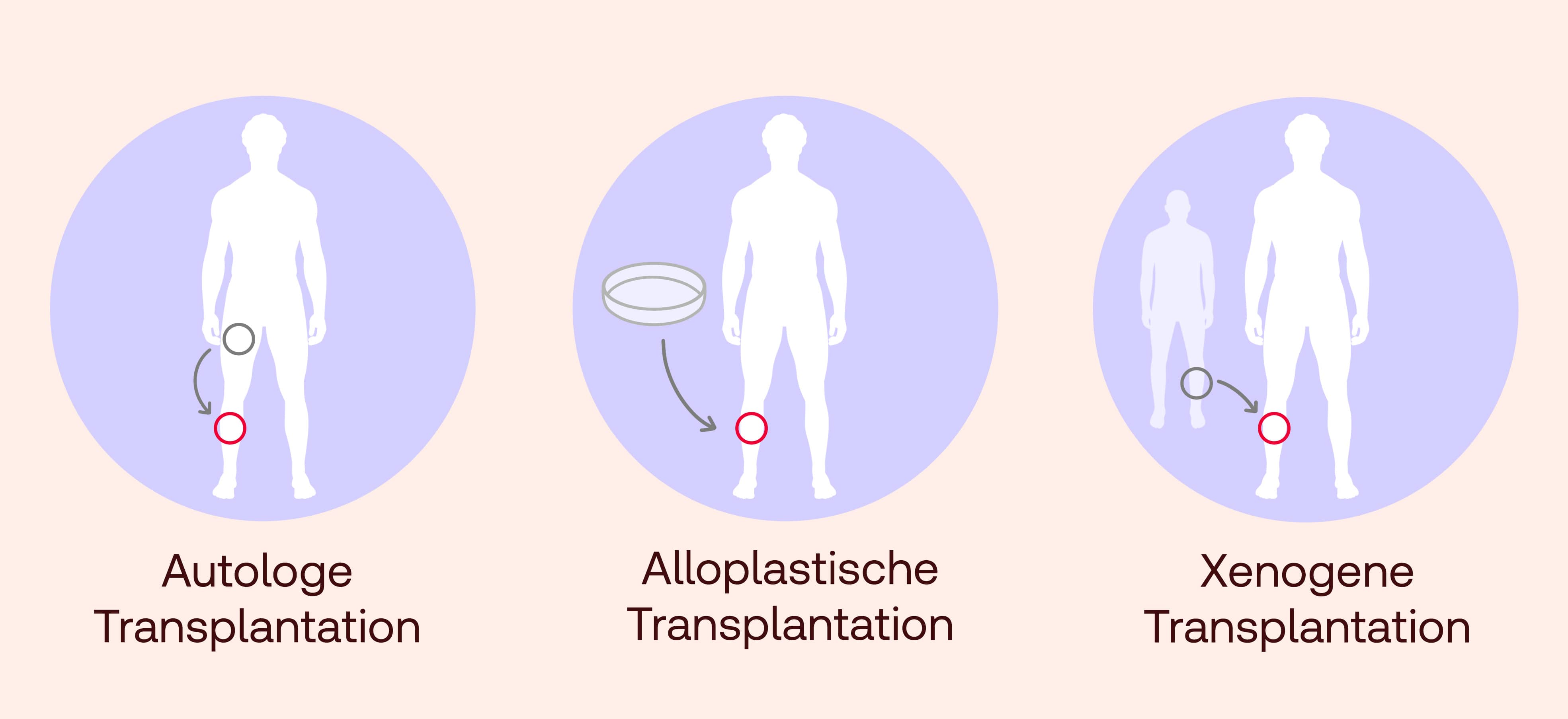 Hauttransplantation Formen