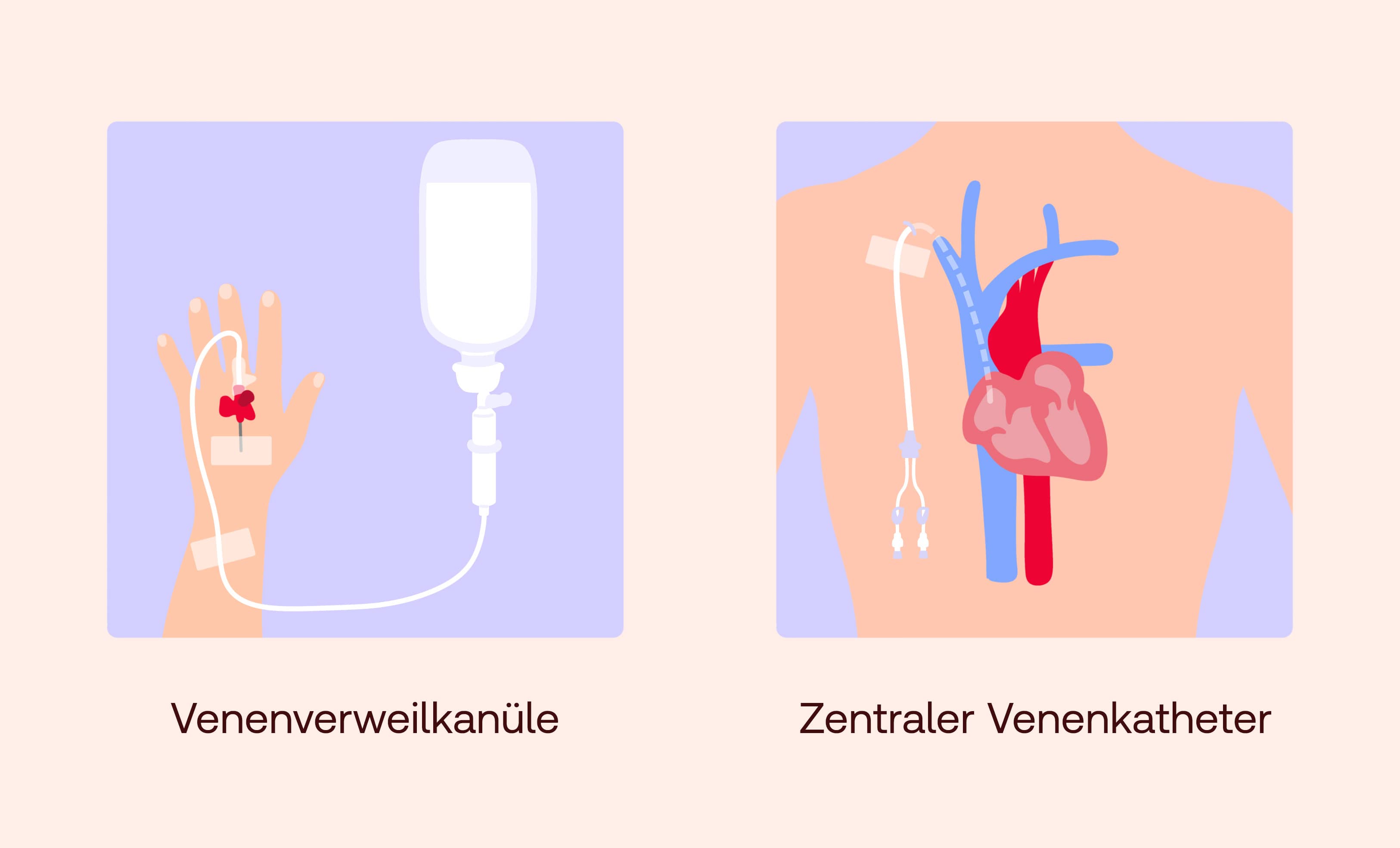 Formen von Infusion