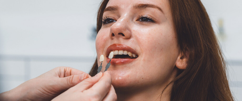 Veneers – schnell schöne Zähne