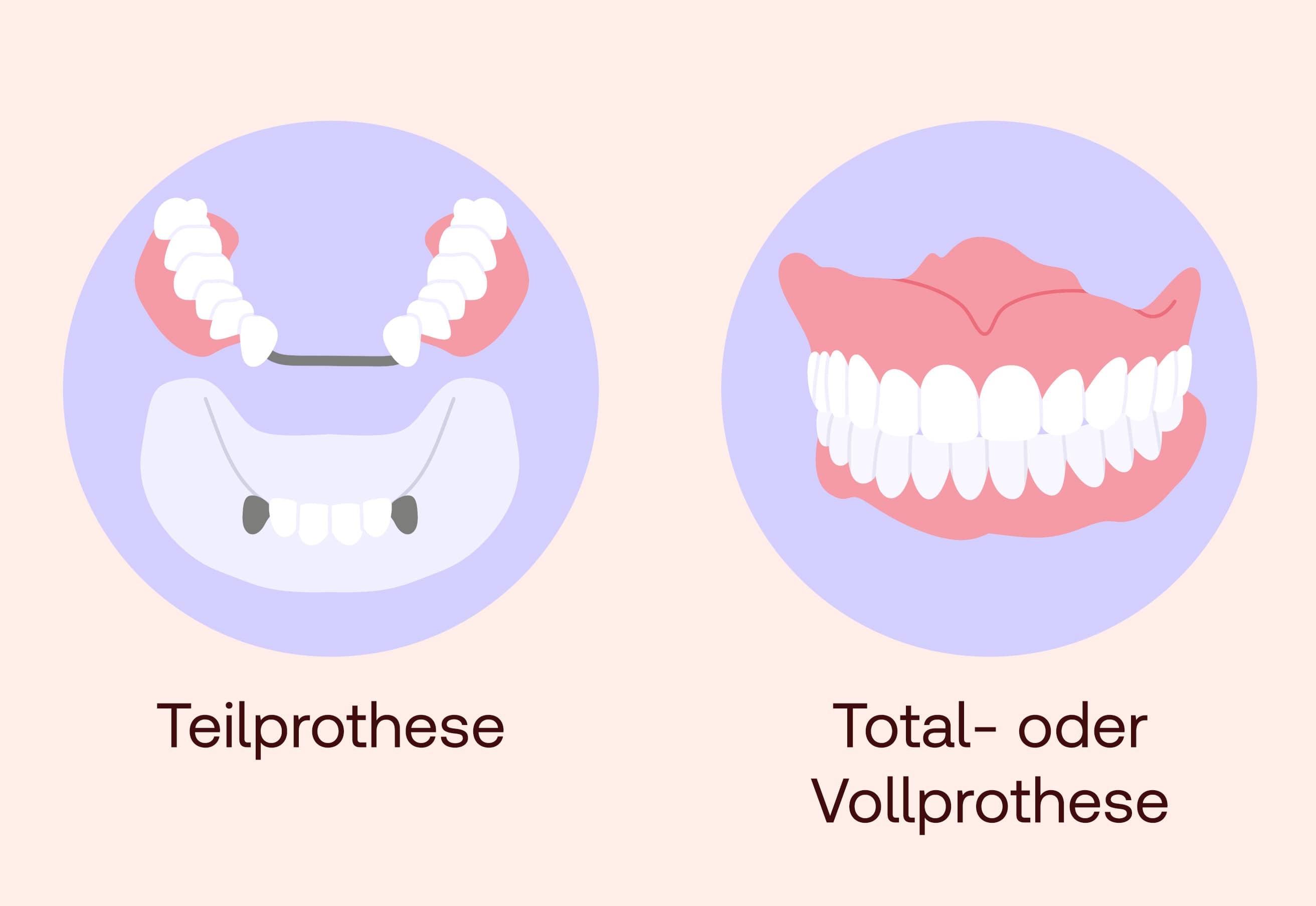 Zahnprothese Arten