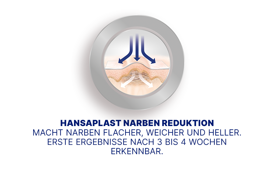 Illustration: Narbenreduktion. Macht Narben flacher, weicher und heller. Erste Ergebnisse nach 3-4 Wochen.