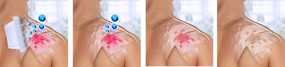 Person mit Pflaster auf dem Rücken. Text: 24 Stunden kontinuierliche Wirkstofffreisetzung.