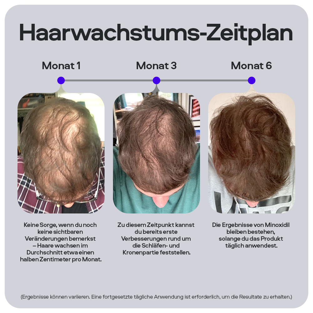 Haarwachstums-Zeitplan. Vorher-Nachher-Bilder nach 1, 3 und 6 Monaten. Text: Ergebnisse von Minoxidil.