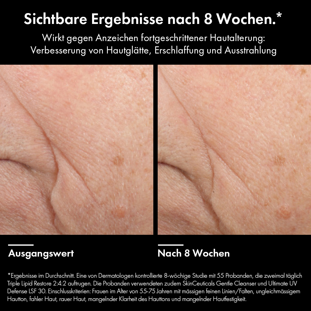 Vorher-Nachher-Bild. Haut vor und nach 8 Wochen Anwendung. SkinCeuticals TRIPLE LIPID RESTORE 2:4:2.