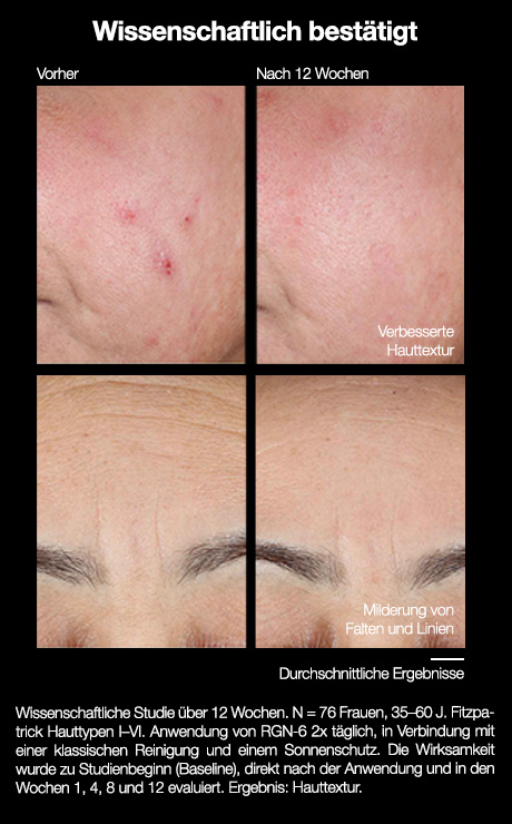Vorher-Nachher-Bilder. Hauttextur verbessert, Falten und Linien gemildert. Wissenschaftlich bestätigt.